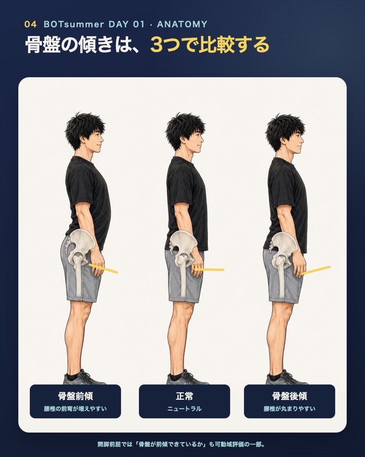 骨盤の傾き 前傾・正常・後傾